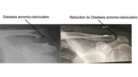 Chirurgies du squelette osseux Clinique de l épaule du coude