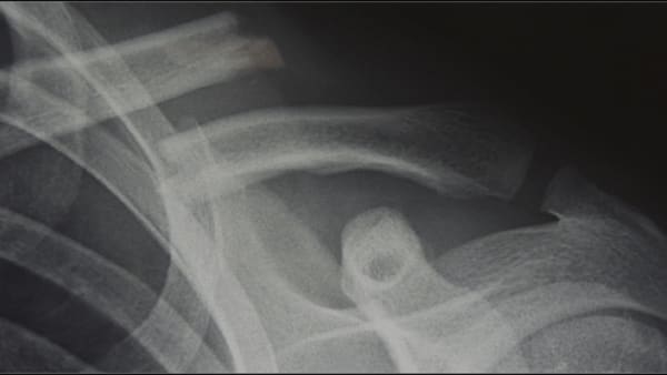 fracture clavicule scanner fracture epaule clavicule cassee epaule chirurgien orthopedique paris chirurgien de l epaule chirurgien du coude