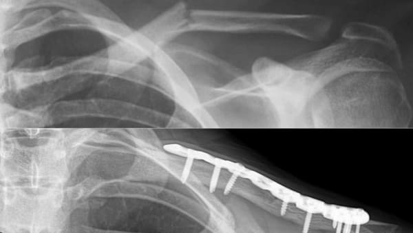 fracture clavicule traitement epaule osteosynthese plaque epaule chirurgien orthopedique paris chirurgien de l epaule chirurgien du coude