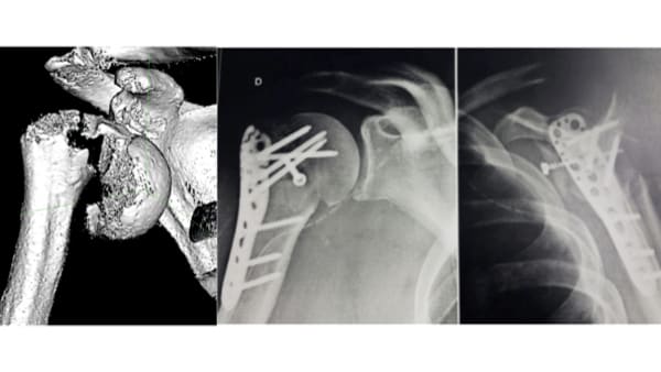 fracture humerus combien de temps epaule osteosynthese plaque epaule chirurgien orthopedique paris chirurgien de l epaule chirurgien du coude