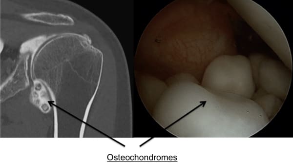 osteochondromatose epaule osteochondromatose traitement epaule chirurgien orthopedique paris chirurgien epaule chirurgien coude