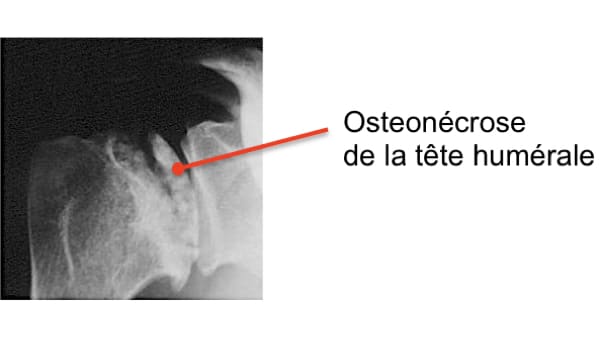 osteonecrose aseptique osteonecrose epaule symptomes osteochondrite epaule chirurgien orthopedique paris chirurgien epaule chirurgien coude