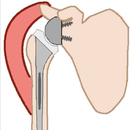 prothese d epaule inversee prothese epaule inversee prothese totale epaule prothese de l epaule reeducation 1 epaule chirurgien orthopedique paris chirurgien de l epaule chirurgien du coude
