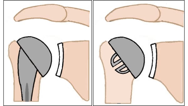 prothese d epaule inversee prothese epaule inversee prothese totale epaule prothese de l epaule reeducation epaule chirurgien orthopedique paris chirurgien de l epaule chirurgien du coude