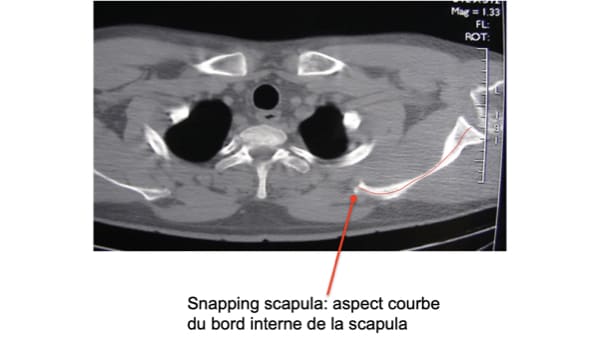 scanner snapping scapula scapula a ressaut douleur omoplate omoplate douleur mal omoplate epaule chirurgien orthopedique paris chirurgien de l epaule chirurgien du coude