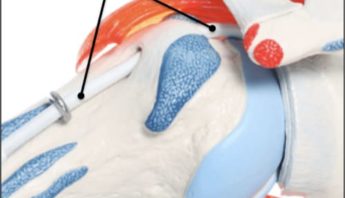 tendinite biceps coude, tendinite au biceps, comment soigner une tendinite du biceps crural epaule chirurgien orthopedique paris chirurgien de l epaule chirurgien du coude