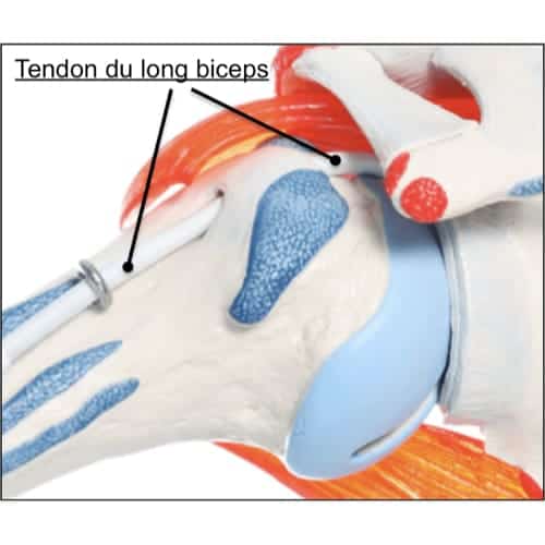 tendinite biceps coude, tendinite au biceps, comment soigner une tendinite du biceps crural epaule chirurgien orthopedique paris chirurgien de l epaule chirurgien du coude