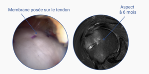 membranes bio-inductives chirurgie du tendon de la coiffe des rotateurs intervention chirurgicale de l epaule dr julien deranlot chirurgien orthopediste specialiste epaule paris